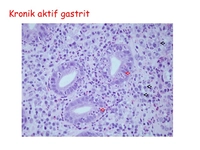 Kronik Aktif Gastrit Belirtileri ve Tedavisi