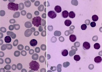 Kronik Lenfositik Lösemi Belirtileri ve Tedavisi