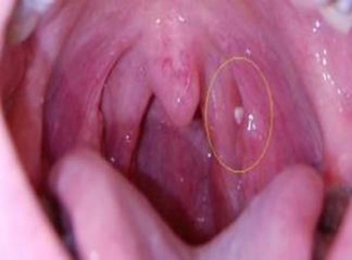 Kronik Tonsillit Belirtileri ve Tedavisi